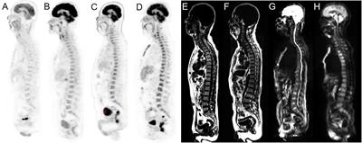 Diagnostic performance of integrated whole-body 18F-FDG PET/MRI for detecting bone marrow involvement in indolent lymphoma: Comparison with 18F-FDG PET or MRI alone